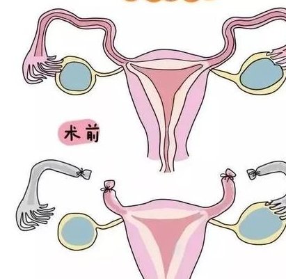 做人工受孕痛吗？做过人的都说不痛